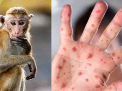 Bệnh đậu mùa khỉ là gì? Dấu hiệu nhận biết đậu mùa khỉ?